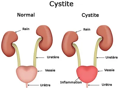 A quoi est due la cystite?