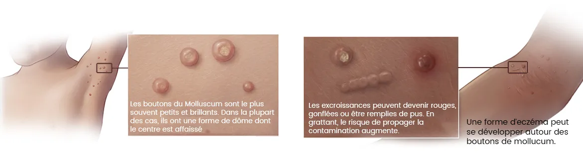 Photo d'une peau infectée par le molluscum avec la légende suivante : les boutons du molluscum sont le plus souvent petit et brillants. Dans la plupart des cas, ils ont une forme de dôme dont le centre est affaissé. les excroissances peuvent devenir rouges, gonflées ou être remplies de pus. En grattant, le risque de propager la contamination augmente. Une forme eczéma peut se développer autour des boutons de molluscum. | Shytobuy.fr