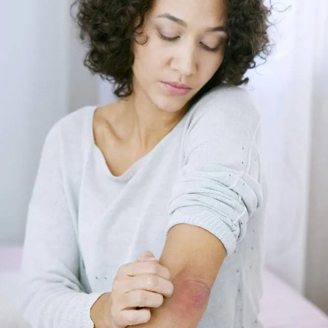 La gale définition, causes et traitements ShytoBuy