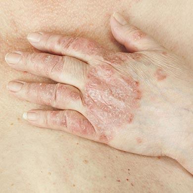 Comment bien soigner l'eczéma de l'enfant ?
