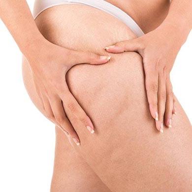 Anti-cellulite : comment se débarrasser de sa cellulite ?