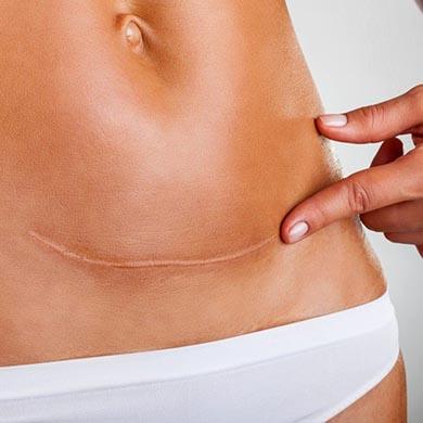 Quelles huiles essentielles pour les cicatrices ?
