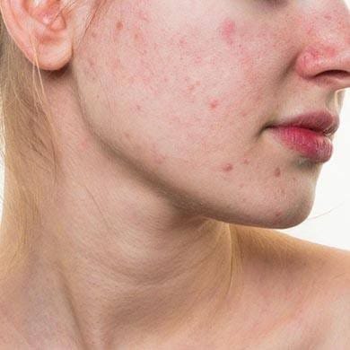Gale: causes, symptômes et solutions contre la gale