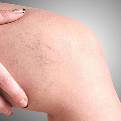 Varices et varicosités : définition, causes et traitements