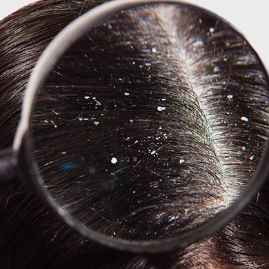 Dandruff is the dead skin that comes off our scalp. If the presence of some dandruff from time to time on our hair is a normal phenomenon, some people suffer from an excess of dandruff, which can be dry or oily and cause undeniable aesthetic discomfort. T