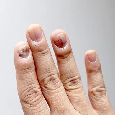 Mycoses des ongles : définition, causes et traitements