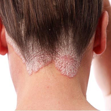 Comment réduire les crises de psoriasis sur le cuir chevelu ?