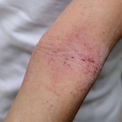 Comment traiter l’eczéma avec les huiles essentielles ?