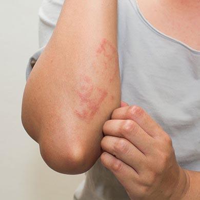Verrues : tout savoir sur les verrues et comment les traiter