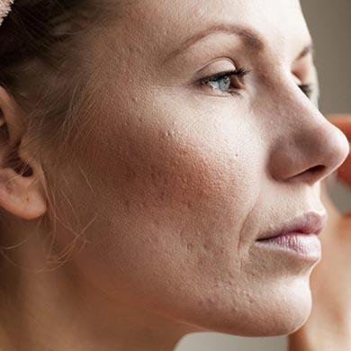 Quelle est la différence entre psoriasis et rosacée ?