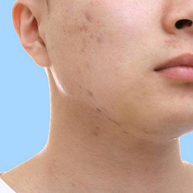 Comment éviter une propagation ou une rechute du Molluscum Contagiosum ?
