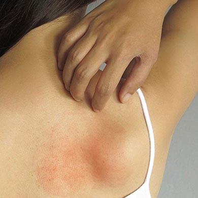 La gale, les premiers gestes pour éviter la contagion