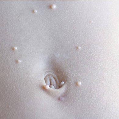 Qu’est-ce qu’est le Molluscum Contagiosum et comment le traiter ?