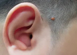 homme avec un acrochordon au dessus de l'oreille