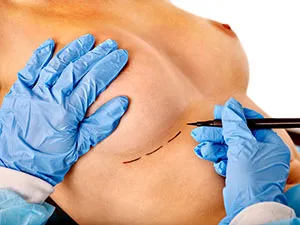 Poitrine de femme sur laquelle un chirurgien trace les marques d'opération de chirurgie plastique - Les meilleures astuces pour une augmentation mammaire sans chirurgie - ShytoBuy France