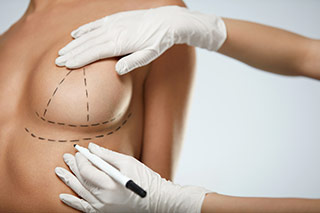 Femme avec marque de feutre caractéristique d'une préparation à une opération chirurgicale des seins - Fenugrec : l'ingrédient idéal pour une poitrine plus grosse