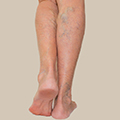 Jambes lourdes que faire pour les soulager ? - Causes symptomes des jambes lourdes : les varices - Shytobuy France