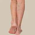 Jambes lourdes que faire pour les soulager ? - Causes symptomes des jambes lourdes : les varices - Shytobuy France